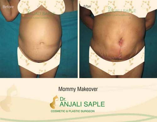 Mommy makeover front view before and after by Dr. Anjali Saple