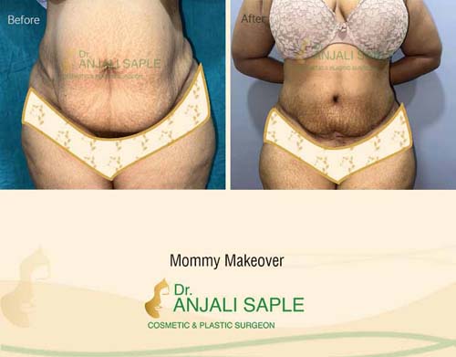 Mommy Makeover Surgery by Dr. Anjali Saple front-view