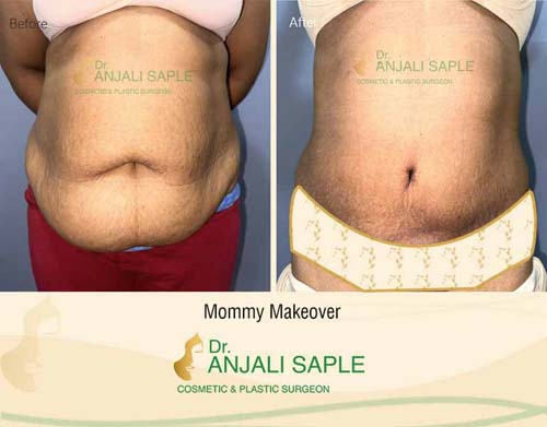 Mommy makeover front view before and after by Dr. Anjali Saple