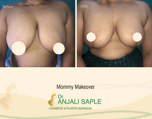 Mommy makeover front view before and after by Dr. Anjali Saple
