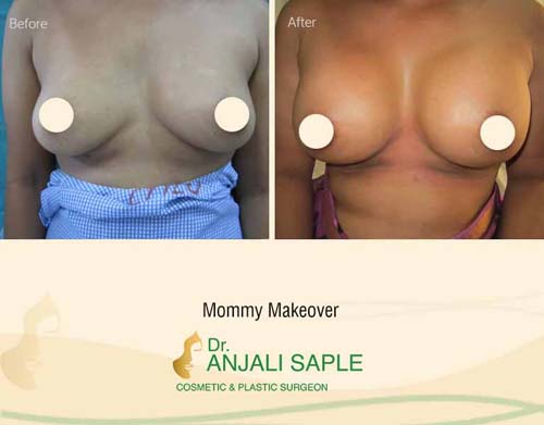 Mommy makeover front view before and after by Dr. Anjali Saple