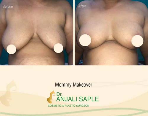 Mommy makeover front view before and after by Dr. Anjali Saple