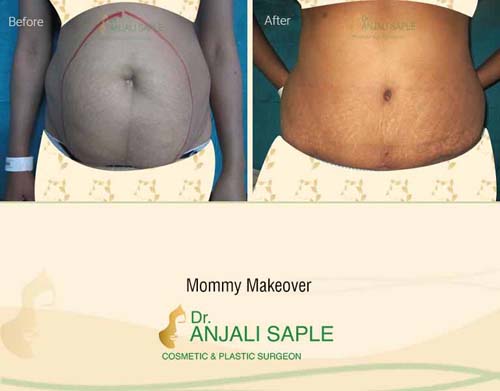 Mommy makeover front view before and after by Dr. Anjali Saple
