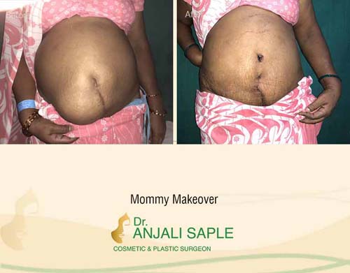 Mommy makeover front view before and after by Dr. Anjali Saple
