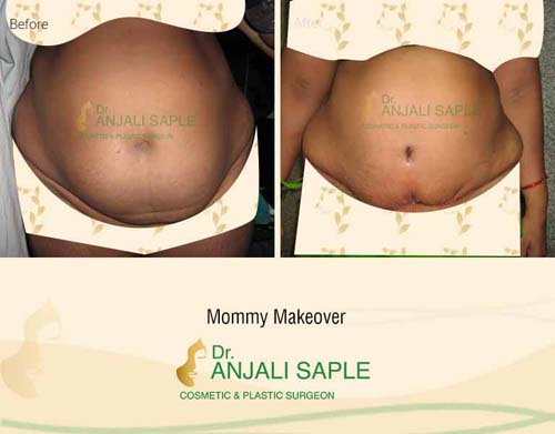 Mommy makeover front view before and after by Dr. Anjali Saple