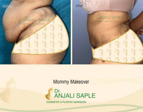 Mommy makeover left side view before and after by Dr. Anjali Saple