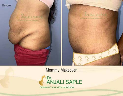 Mommy makeover left side view before and after by Dr. Anjali Saple