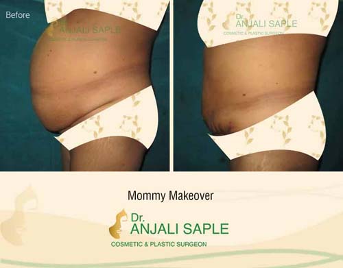 Mommy makeover left view before and after by Dr. Anjali Saple