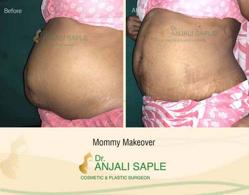 Mommy makeover left view before and after by Dr. Anjali Saple