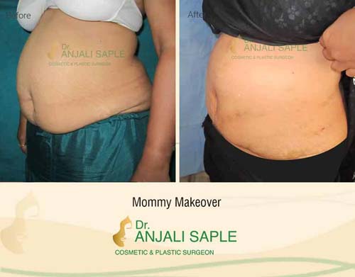 Mommy makeover left view before and after by Dr. Anjali Saple