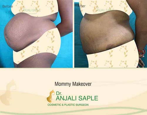 Mommy makeover left view before and after by Dr. Anjali Saple