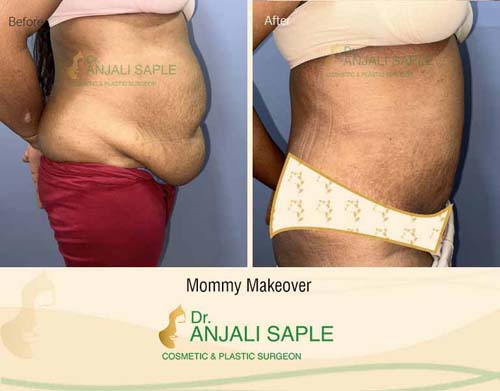 Mommy makeover right side view before and after by Dr. Anjali Saple