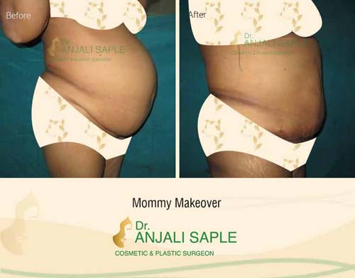 Mommy makeover right view before and after by Dr. Anjali Saple