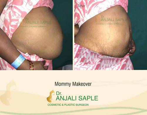 Mommy makeover right view before and after by Dr. Anjali Saple