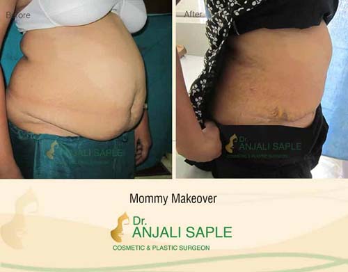 Mommy makeover right view before and after by Dr. Anjali Saple
