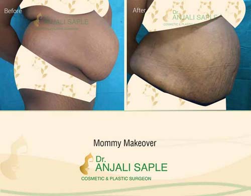 Mommy makeover right view before and after by Dr. Anjali Saple