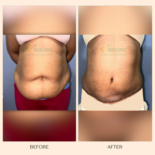 Mommy Makeover