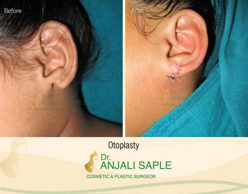 Otoplasty before and after by Dr. Anjali Saple