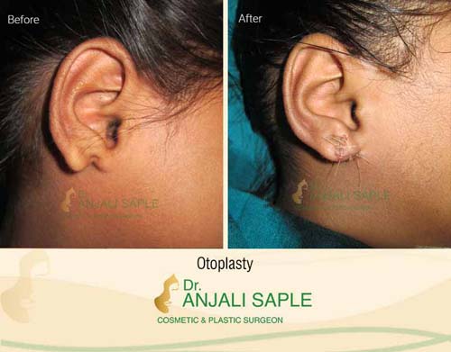 Otoplasty before and after by Dr. Anjali Saple