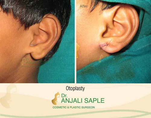 Otoplasty before and after by Dr. Anjali Saple