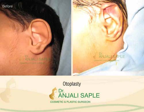 Brachial plexus injuries before and after by Dr. Anjali Saple