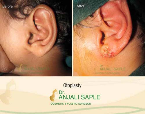 Otoplasty before and after by Dr. Anjali Saple