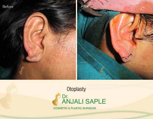 Otoplasty before and after by Dr. Anjali Saple