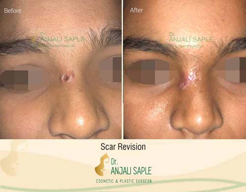 Scar management case 1 before and after by Dr. Anjali Saple