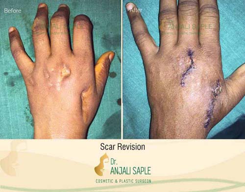 Scar management case 5 before and after by Dr. Anjali Saple