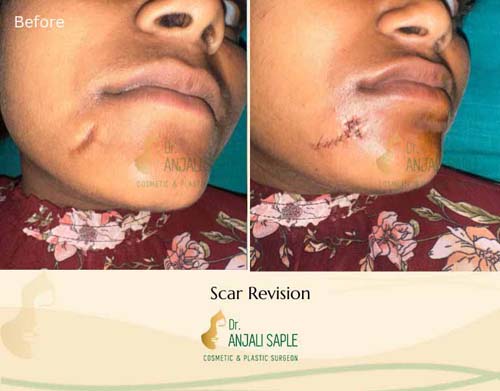 Scar management before and after by Dr. Anjali Saple