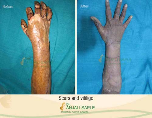Scar and vitiligo management before and after by Dr. Anjali Saple