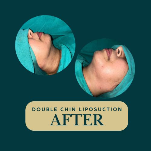 Double Chin Liposuction - After