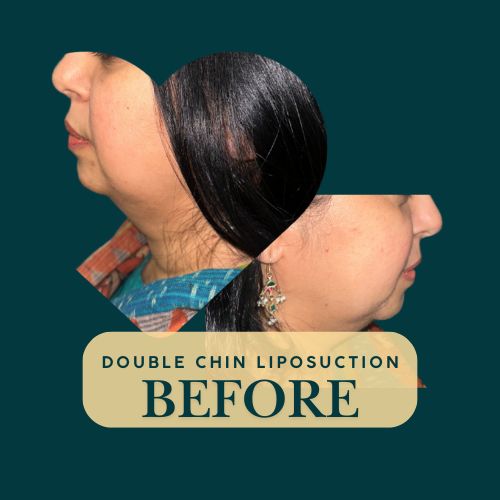 Double Chin Liposuction - Before