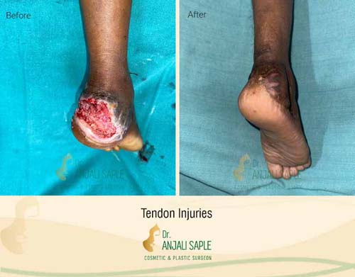 Brachial plexus injuries before and after by Dr. Anjali Saple