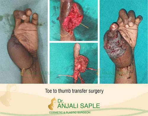 Toe to thumb transfer surgery before and after by Dr. Anjali Saple