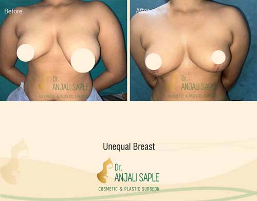 Unequal breast front view before and after by Dr. Anjali Saple