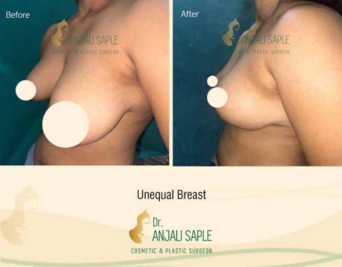 Unequal breast left side view before and after by Dr. Anjali Saple