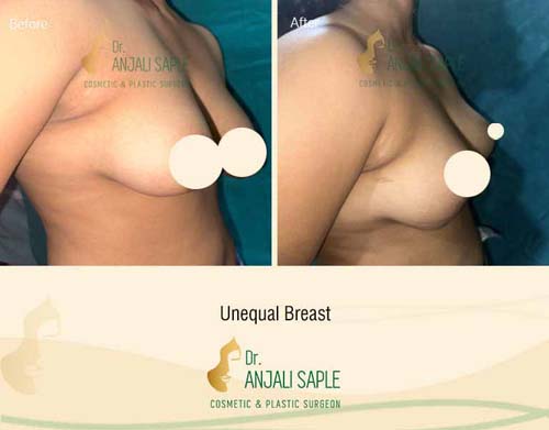 Unequal breast right side view before and after by Dr. Anjali Saple