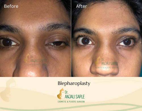 Blepharoplasty before and after by Dr. Anjali Saple