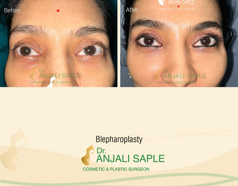 Blepharoplasty Surgery by Dr. Anjali Saple front-view