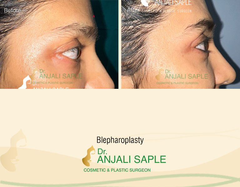Blepharoplasty Right view
