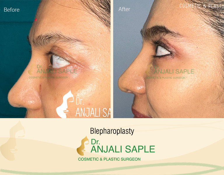 Blepharoplasty Surgery by Dr. Anjali Saple Left-Side-view