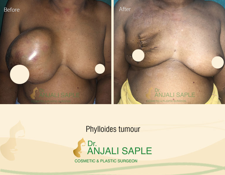 Breast Reconstruction Phylloides Tumour
