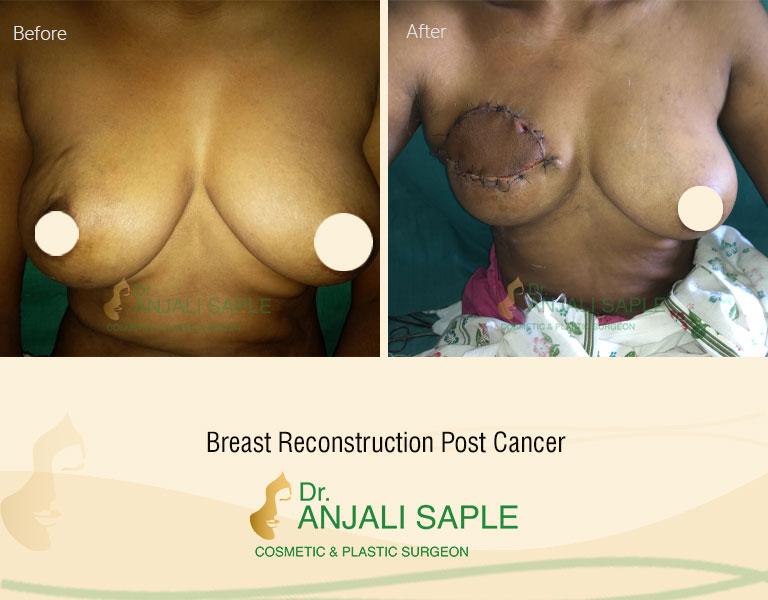 Breast Reconstruction Post cancer