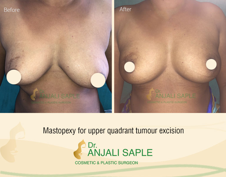 Breast Reconstruction Mastopexy