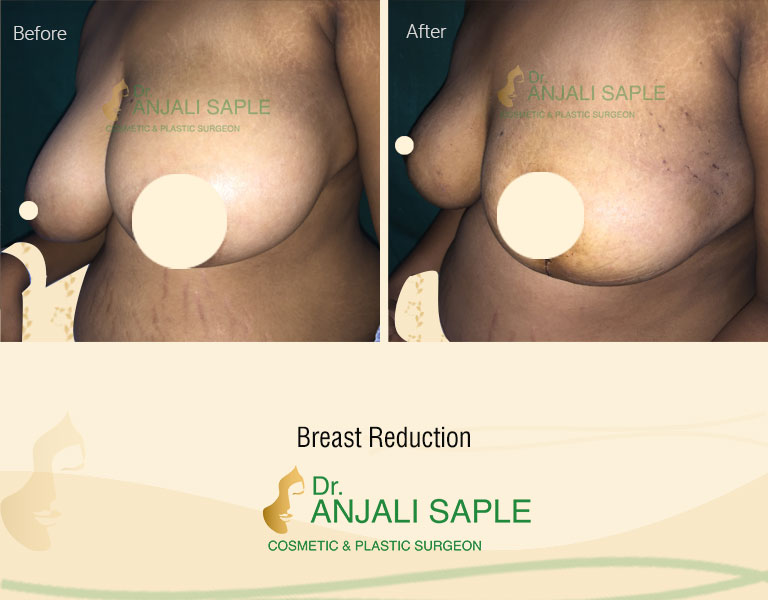 Breast Reduction Left Side View