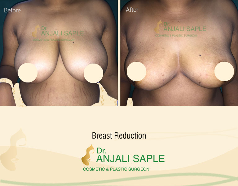  Breast Reduction Front View