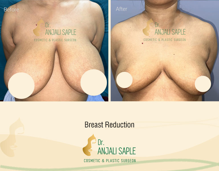 Breast Reduction Front View