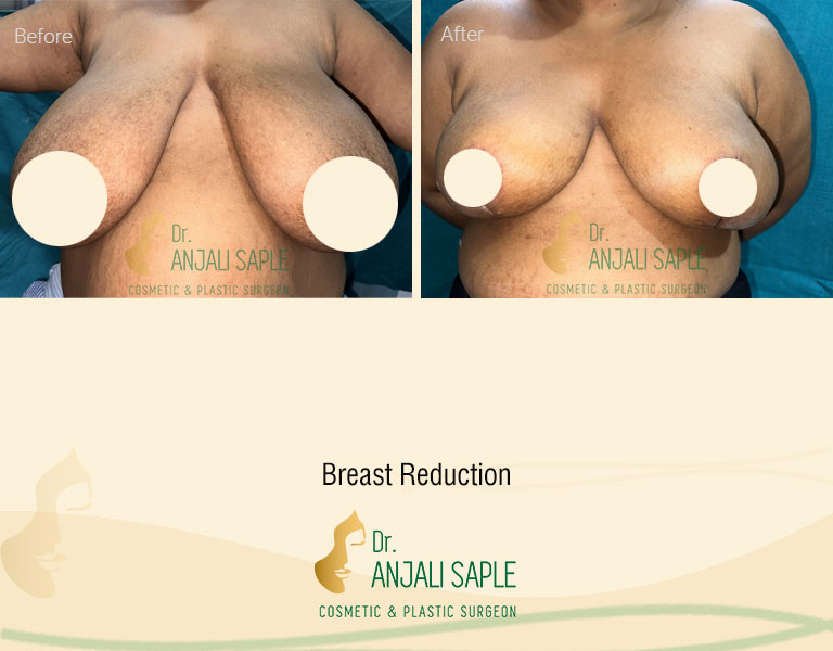Front view of before and after image for breast reduction surgery