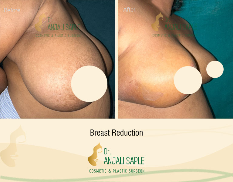 Right side view of before and after image for breast reduction surgery